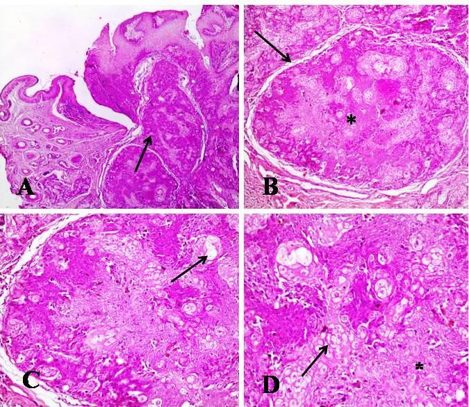 Figura 4 Carcinoma Meibomiano Canino. Cão, Fêmea, Poodle de 12 anos de idade. (A) Massa neoplásica em derme, multilobulada, bem delimitada composta por células carcinomatosas (seta). Obj. 4x, HE.