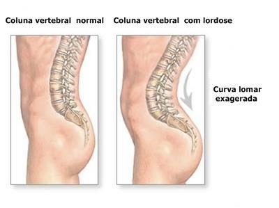 25 4.5 ALTERAÇÕES MÚSCULO ESQUELÉTICAS A coluna vertebral possui quatro curvaturas fisiológicas a curvatura cervical, lombar, torácica, e sacral, dispostas umas sobre as outras e quando saudáveis