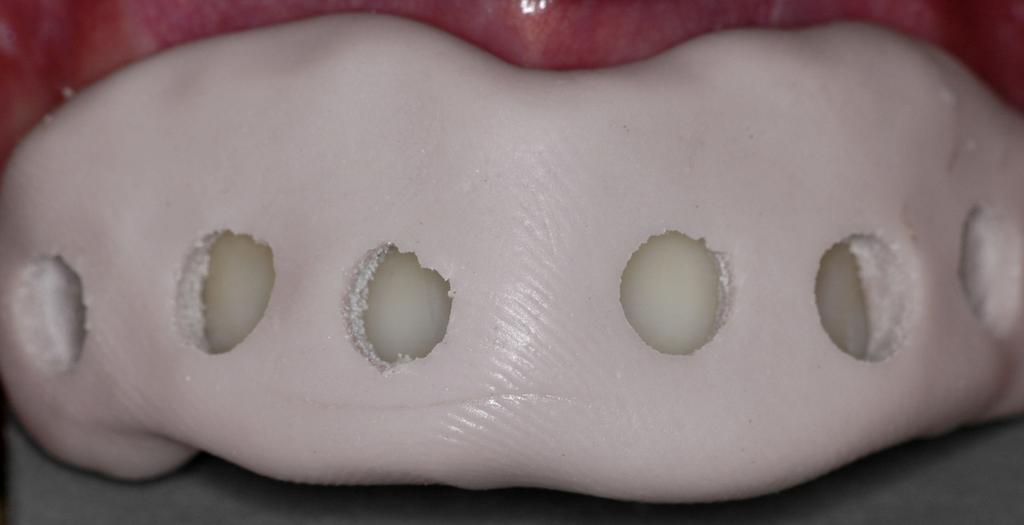 70 Figura 2 - Guia de silicone posicionada sobre a face vestibular dos dentes anteriores superiores a serem mensurados.