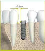 plataforma do implante e dente adjacente no sentido mesio- distal. Figura 7.