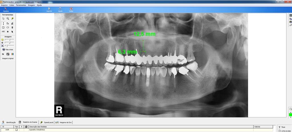 Materiais e Métodos 63 implantes, Ribeirão Preto Sp/ Sin, São Paulo Sp/ TitaniumFix, São José dos Campos Sp/ Dérig,São Paulo-Sp/ Dentoflex, São Paulo-Sp/ Neodent,Curitiba Pr/Conexão, Arujá-Sp/