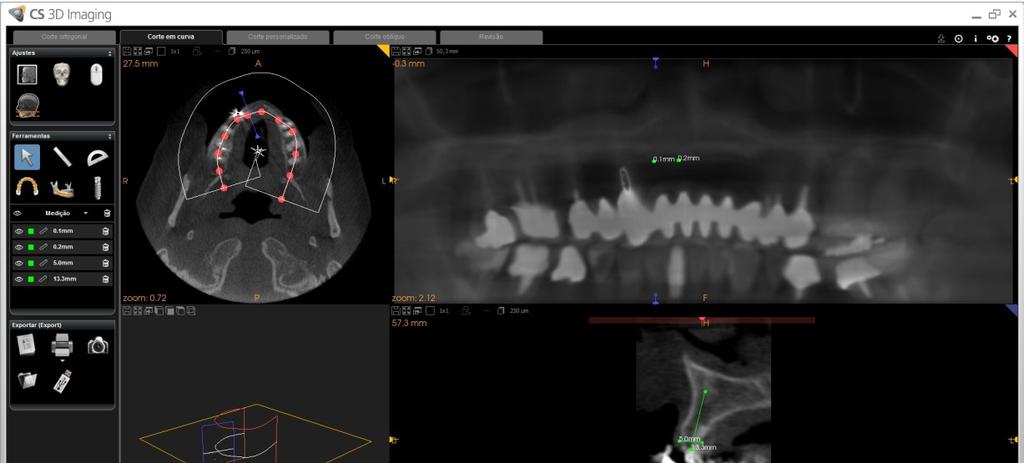 64 Materiais e Métodos As avaliações dos exames de imagem foram realizadas em monitor de alta resolução e em ambiente escurecido adequado para análise das imagens.