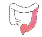 Doença de Crohn A DC é caracterizada por um processo inflamatório crónico, heterogéneo e granulomatoso que afeta todas as camadas do trato gastrointestinal, podendo envolver qualquer porção, desde a