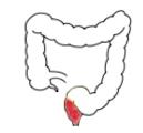 1,2,5,8 Muito frequentemente os doentes possuem segmentos de intestino normal intercalados por segmentos de intestino afetados, resultando numa patologia descontínua.