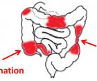 efetividades ou que apresentam febre, perda de peso, dor abdominal, vómitos, obstrução intestinal e anemia significante; severa a fulminante apresenta sintomas persistentes ou evidências de