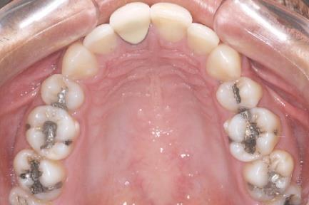 Oclusal superior; E) Oclusal