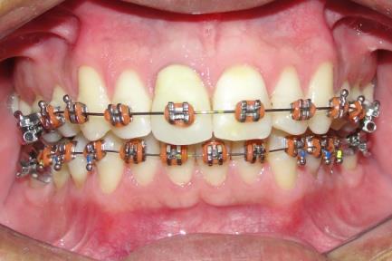 os dentes 14 e 24,e os espaços já estavam fechados. Devido a esse achado essa opção de tratamento foi descartada.