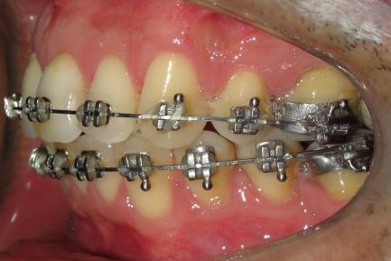 intrabucal lateral direita com