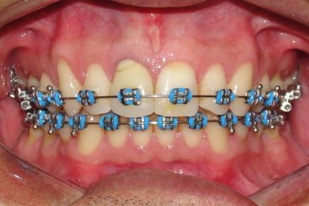 48). Nesta etapa do tratamento o paciente utilizou os elásticos intermaxilares 1/8, do dente 18 ao 48 e