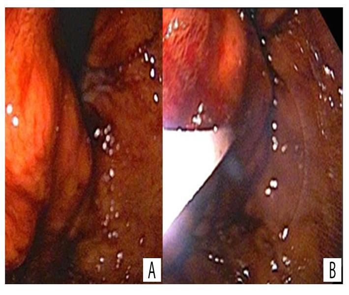 Presença de Hemosuccus Pancreaticus. O paciente foi submetido à angiografia diagnóstica e terapêutica com embolização da artéria esplênica com Gelfoam e Lipidiol.