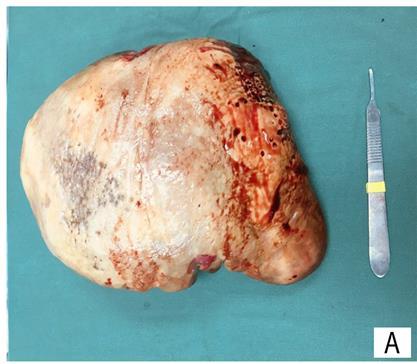 Solicitado exames de função e lesão hepática sem alterações e TC de abdômen com contraste, evidenciou-se esplenomegalia com dilatação de veia esplênica em hilo (Figura 5). Figura 6 A.