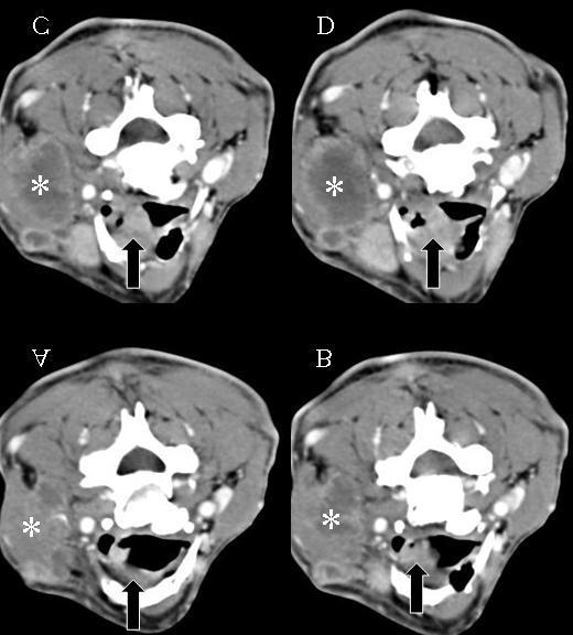 R EVISÃO DA L ITERATURA 26 Figura 4 TC de pescoço realizada com cortes axiais, demonstrando o envolvimento do EPE por carcinoma epidermóide de supraglote.