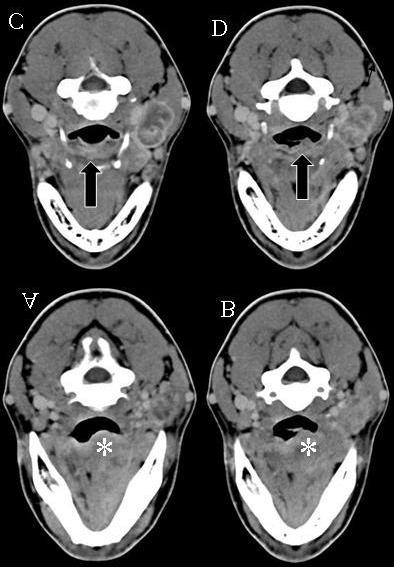 R EVISÃO DA L ITERATURA 27 Figura 5 TC de pescoço realizada com cortes axiais, demonstrando o acometimento do EPE por um carcinoma de base de língua