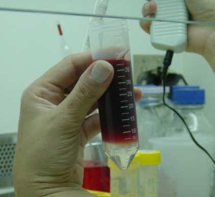 As amostras de aspirado medular também foram diluídas em HBSS na proporção de 1:1 e processadas para o isolamento de células