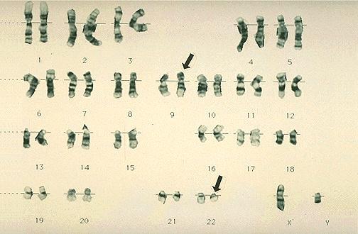 A B Figura 13. Identificação da cromossoam de Filadélfia por citogenética convencional (A) e por FISH (B).