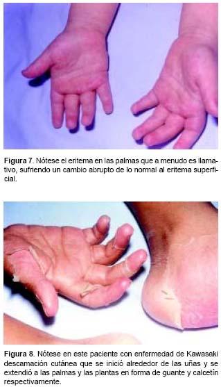 Quadro Clínico Alteração nas extremidades Eritema palmar e plantar e/ou edema de mãos ou pés;