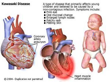 Manifestações Cardíacas A doença de Kawasaki é a maior causa de doença cardíaca adquirida na infância nos