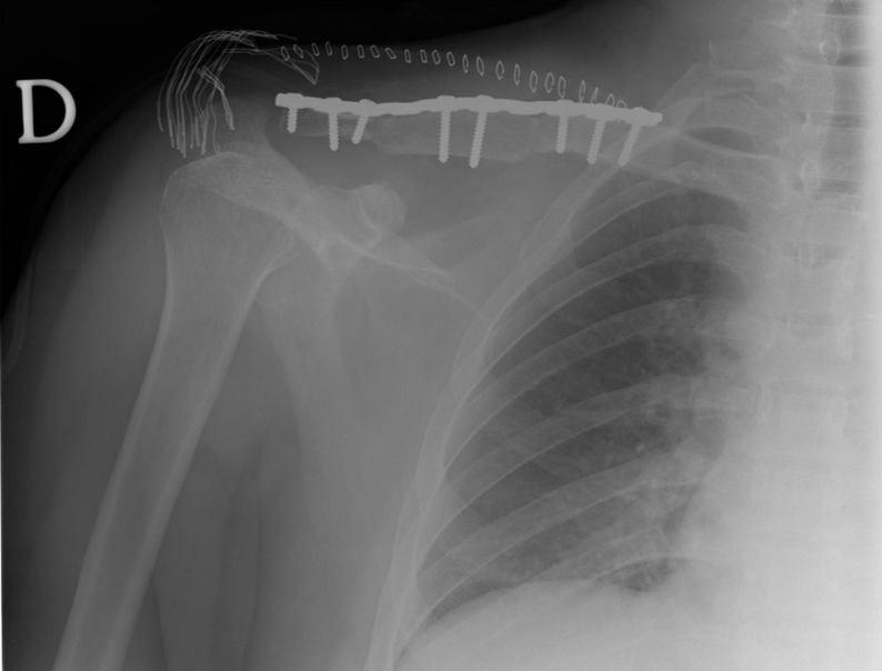 Fig. 5 Radiografia pós operatória. Fixação de fractura da clavícula com colocação de enxerto e material de osteossíntese. Fig. 3 Cintilografia Óssea.