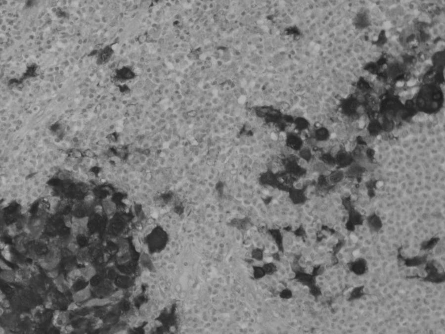 Identificam-se ainda, na maioria das áreas examinadas abundantes polimorfonucleares eosinófilos, linfócitos pequenos, plasmócitos e escassas células gigantes multinucleadas.