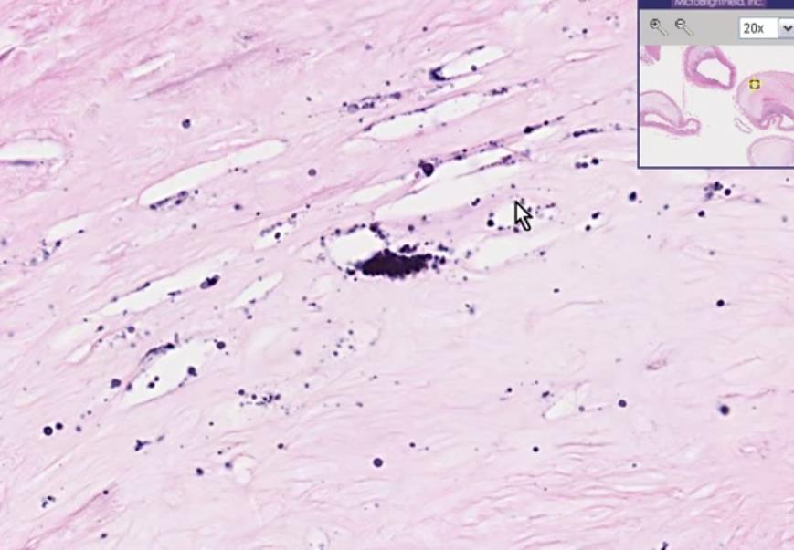 Consequências da Aterosclerose O constante crescimento dos ateromas pode levar a: trombose (formação de trombos devido ao rompimento e precipitação de placas e ulceração dos vasos, o que leva à