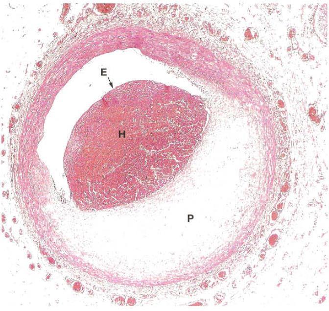 Hemorragia (H) na placa ateroesclerótica (P) por fissuração da placa ou por rompimento de vasos desenvolvidos nesta.