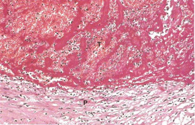 Fig.1. Trombo Precoce (P- Parede celular): obeserva-se parede arterial danificada por ateroma o que levou à formação de um trombo no local de lesão (T- Trombo).