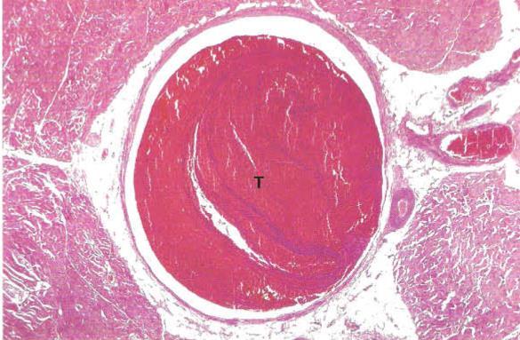 (imagem da trombose arterial: observa-se acumulação de plaquetas após ruptura de placa ateroscleróticas e exposição de factores pro-coagulantes (TM- trombomodulina, II, fibrina,