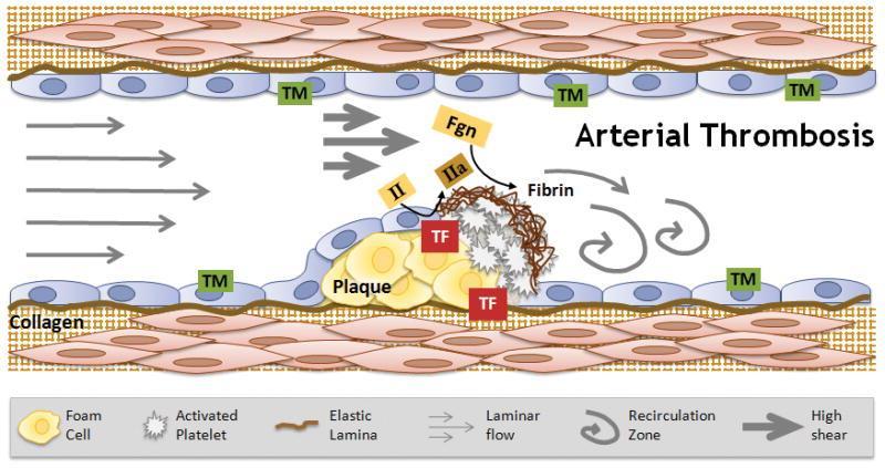 associated with plasma hypercoagulability and thought to be triggered by expression of procoagulant activity on intact endothelium from inflammation and/or stasis/reduced blood