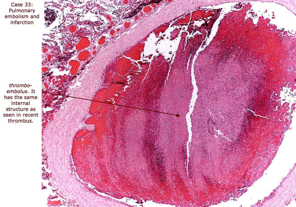 Tromboembolismo: imagem na qual se observa tecido pulmonar e artéria pulmonar obstruída devido a êmbolo (E).