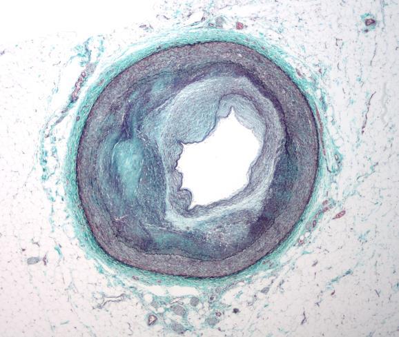 2.2 - Acumulação de lípidos na íntima vascular Caracteriza-se por lesões da túnica íntima chamadas ateromas, placas ateromatosas ou placas ateroscleróticas que fazem protusão para o interior do lúmen