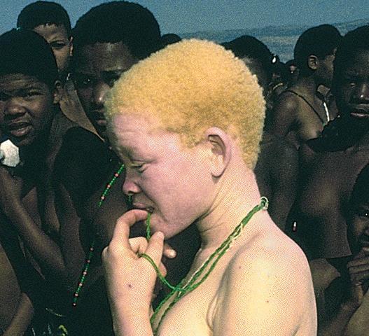 Exemplos de doenças monogênicas Albinismo: ausência ou