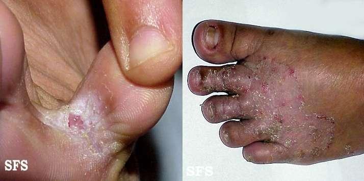 Figura 2 Tinea do pé. Fonte: http://www.atlasdermatologico.com.br/disease.jsf?diseaseid=459 A pediculose é subdividida em capilar (popularmente conhecida como piolho ) e corporal.