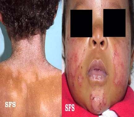 Figura 4 Dermatite atópica no adulto e na criança. Fonte: http://www.atlasdermatologico.com.br/disease.jsf?