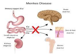 Doença de Menkes Kinky hair syndrome êcu sérico e ceruloplasmin ATPase gene (ATP7A) transporte Cu X-linked recessive MALES tyrosinase