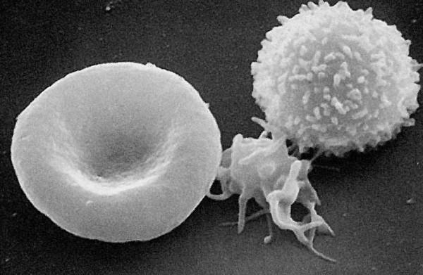 Leucopenia e plaquetopenia.