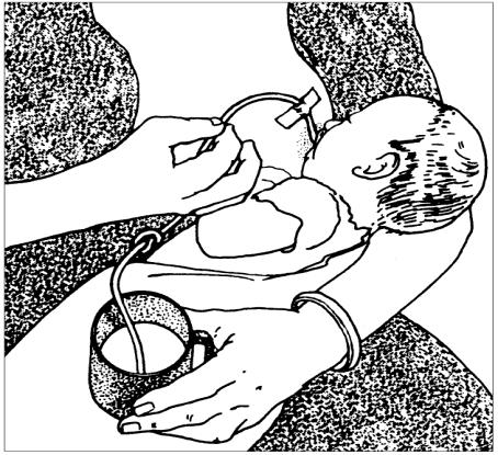 Técnica de Sucção Suplementar (TSS) Objectivo: Restabelecimento ou o início da amamentação, e também fornecimento de quantidades suplementares de F100-diluído para crianças com desnutrição aguda