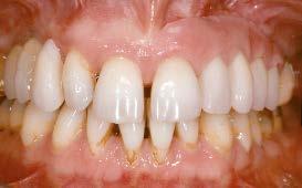 periodontal e extração dos quatro incisivos