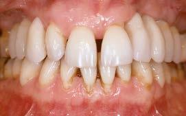 7b Aspecto após a conclusão da terapia periodontal,