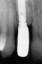 um dente por meio de próteses ( 7.4).