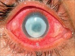 Aspectos clínicos Acanthamoeba spp Ceratite amebiana Inflamação da córnea por espécies do gênero Acanthamoeba Os principais fatores de risco são: Uso prolongado de lentes de contato; Traumas ou
