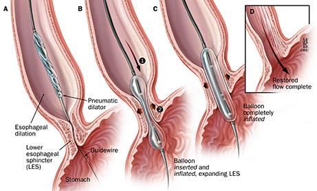 Modalidades terapêuticas da acalasia Dilatação