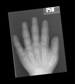 (2017) para determinar os limites inferiores de cada um dos dedos e também para a remoção do excesso de punho.