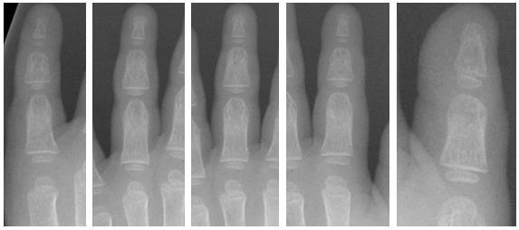 48 Caso o processo de segmentação dos dedos não encontre cinco regiões, a imagem do raio-x é automaticamente descartada e não comporá a base de dados de treinamento e testes.