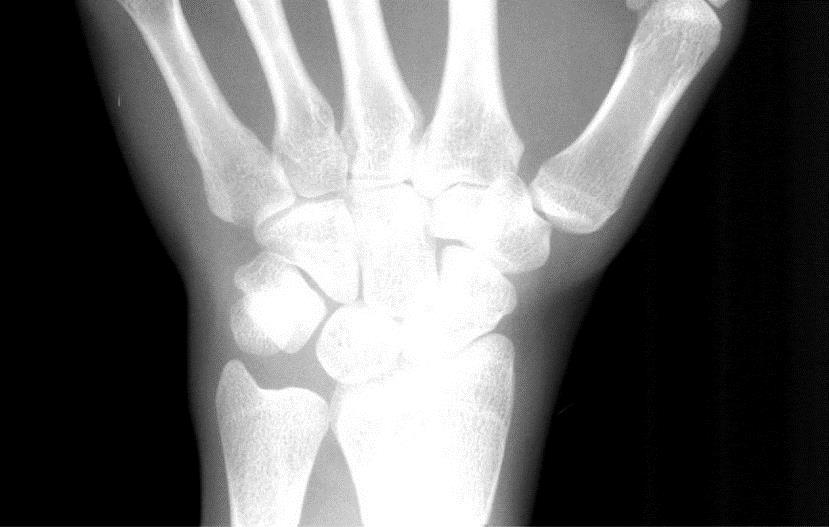 54 clássicos para a estimação da idade óssea. Por essa razão, essa parte do raio-x foi incorporada no mosaico dos dedos e dos centros de ossificação.