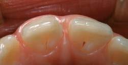 superfície dentária fraturada em sua porção mais apical, com broca