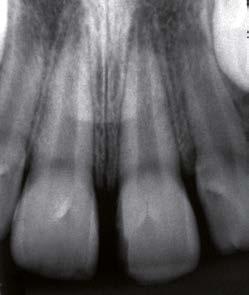 Figura 2: Visão aproximada da fratura dentária verticalizada.