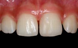 O pós-operatório mostrou uma situação clínica favorável, evidenciada pela ausência de sangramento à sondagem periodontal aos 7, 14, 60 e 120 dias (Fig. 14-19).