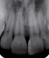 RESTAURAÇÃO TRANSCIRÚRGICA PARA O RESTABELECIMENTO DA ESTÉTICA DENTÁRIA E PERIODONTAL Figura 20: Acompanhamento periodontal de 34 meses.