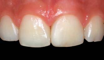 Figura 23: Aspecto final do caso associado à saúde periodontal da área operada. reabilitação satisfatória e compatível com a biofisiologia dos tecidos periodontais (Fig. 20-23).