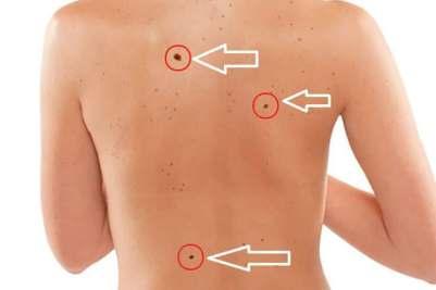 EXAME PELE Diagnosticar o câncer de pele precocemente é muito importante, pois existem bons índices de cura nesses casos.